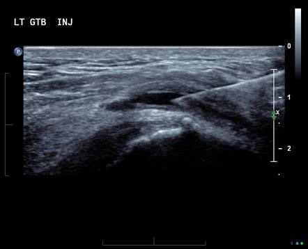 Trochanteric bursitis | Radiology Reference Article | Radiopaedia.org