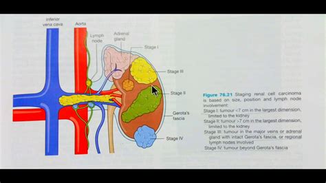 Renal cell carcinoma -staging and management - YouTube