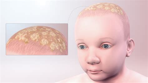 Cradle Cap: Symptoms, Causes, and Treatment - Scientific Animations