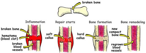 How To Heal Broken Bones » Corestep