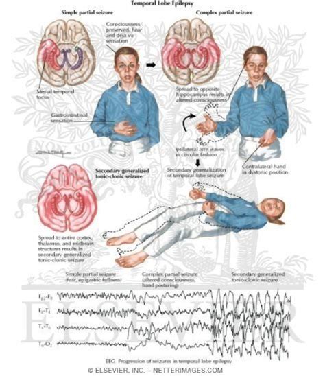 Grand mal seizure medical definition 2021