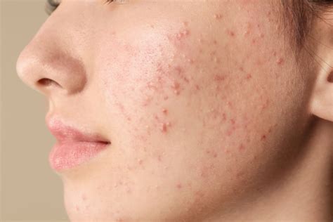 How to get rid of cheek acne? - NETGENICS