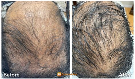 Hair Restoration - RN Laser & Med Spa