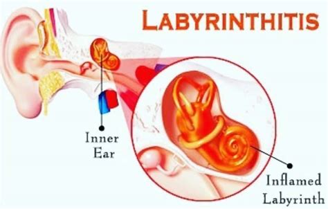 Labyrinthitis causes, symptoms, prognosis, diagnosis, exercise & treatment