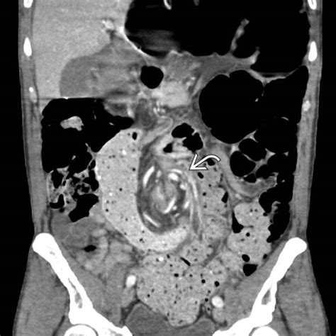 Sigmoid Volvulus | Clinical Gate