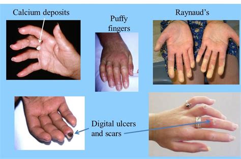 Alternative Herbal Treatment of Scleroderma - Herbs Solutions By Nature