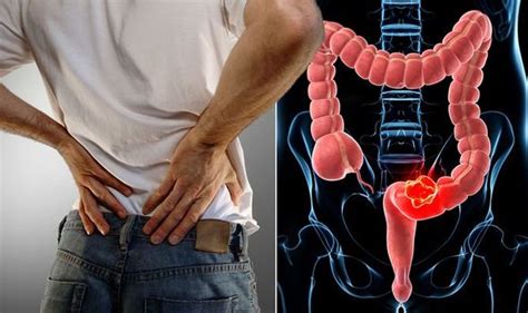 Bowel cancer warning - the pain in your back passage you should never ignore - UWINHEALTH