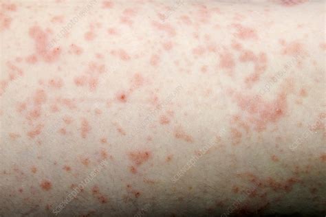 Viral urticaria - Stock Image - C021/3311 - Science Photo Library