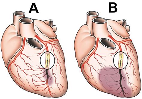 Collateral circulation definition, coronary collateral circulation & collateral circulation brain