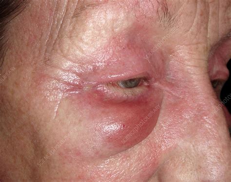 Skin rash in dermatomyositis - Stock Image - C026/9079 - Science Photo ...