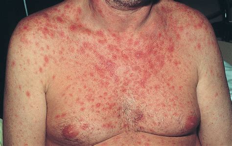 A Maculopapular Rash in a Patient With Severe Diarrhea | Dermatology | JAMA Dermatology | The ...