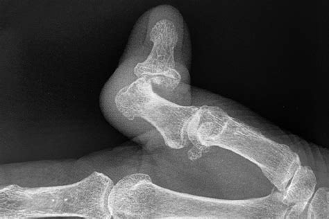 SPRAIN, THUMB INTERPHALANGEAL (IP) JOINT | Hand Surgery Resource