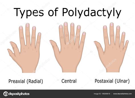 23+ Polydactyly Thumb - Furry Kittens