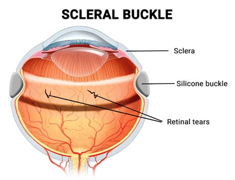 Scleral Buckle Procedure - Vitreous Retina Macula Consultants of New York