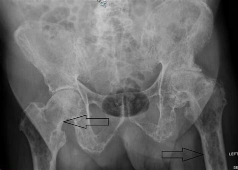 Cureus | Morbidity and Mortality: A Case Report of Metastatic Bone Disease