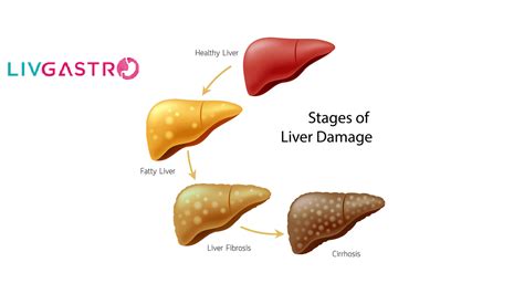 Fatty Liver Disease: Forms, Symptoms, Diagnosis & Treatment LivGastro