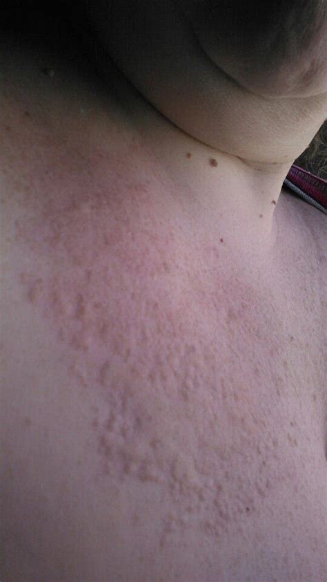 Hives from chest to forehead. | Urticaria, Hives, It hurts