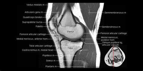 Knee Anatomy Mri