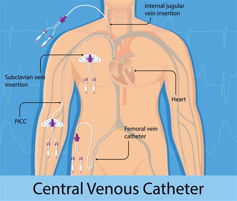 Central Venous Catheter