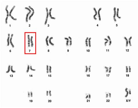 Chromosome 7, Partial Monosomy 7p: Những điều cần biết | Vinmec