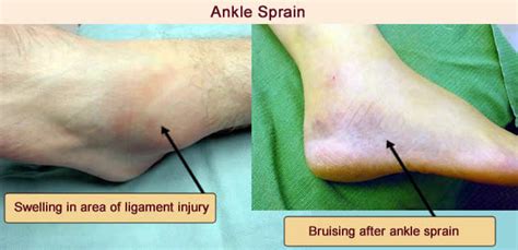 Ankle Sprains - Indy Podiatry - Michael J. Helms, DPM - Podiatrist ...