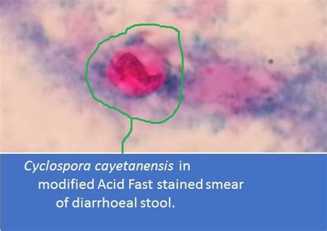 Cyclospora cayetanensis in modified acid fast stained smear of diarrheal