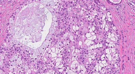 Mucoepidermoid carcinoma | MyPathologyReport.ca