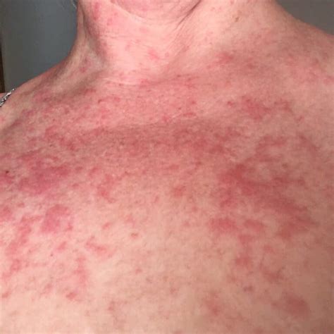 6 details about sun allergy, polymorphic or polymorphous light eruption