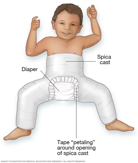 Hip dysplasia - Diagnosis and treatment - Mayo Clinic