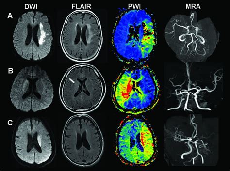 Reperfusion Therapy in Unclear-Onset Stroke Based on MRI Evaluation ...