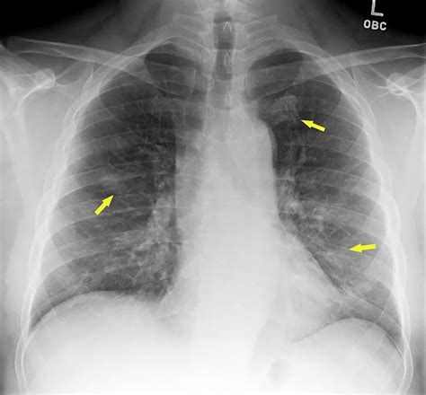 A Coronavirus Disease 2019 (COVID-19) Patient with Multifocal Pneumonia Treated with ...