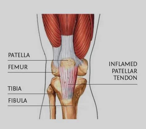 Patellar Tendonitis/Jumper's Knee Symptoms, Causes And Treatment | atelier-yuwa.ciao.jp