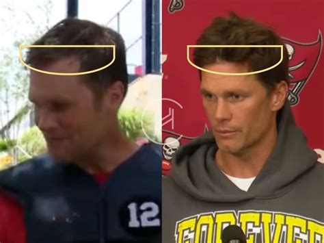 Tom Brady Hair Transplant - Hair Loss & Technical Analysis