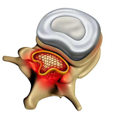 What is Spinal Stenosis? - Orthopaedic Medical Group of Tampa Bay