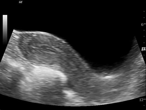 Dermoid cyst ultrasound - wikidoc