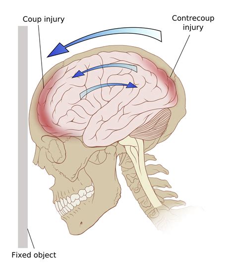 Traumatic Brain Injury Nursing Management - RNpedia