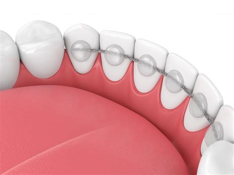 Fixed vs. Removable Retainers | The Pros & Cons of Each