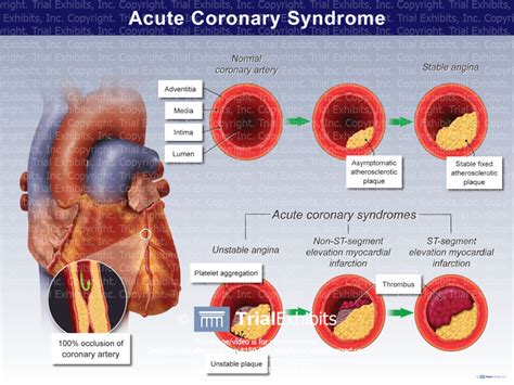 Acute Coronary Syndrome - TrialQuest Inc.