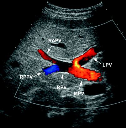 Ultrasound of the Hepatoportal Circulation | SpringerLink