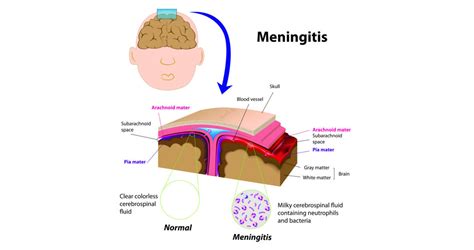 Meningitis | Headway