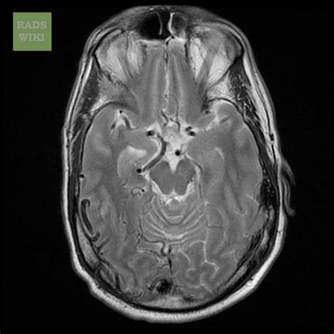 Arteriovenous malformations MRI - wikidoc