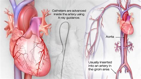 Cardiac Catheterization - The Cardiac Institute