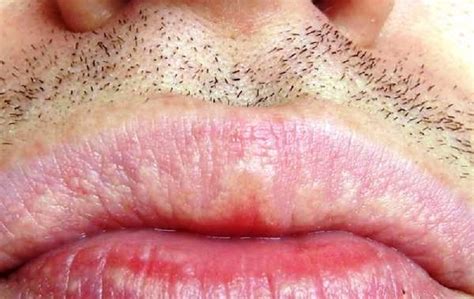 Black Spot Mouth Cancer