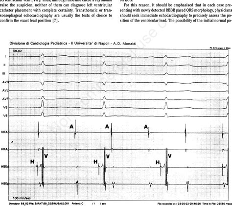 Electrophysiologic study, switching-off the pacemaker: third degree AV ...