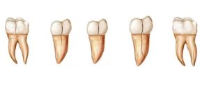 What is VRF (vertical root fracture) and cracked tooth syndrome? | News | Dentagama