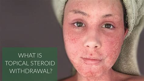 Topical Steroid Withdrawal