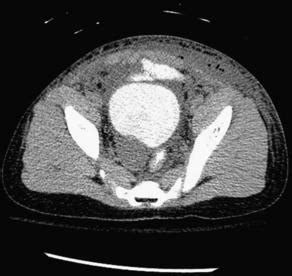 Bladder Injury | Musculoskeletal Key