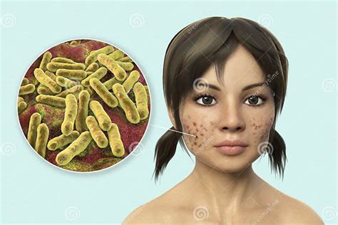 Acne Vulgaris on Skin and Closeup View of Bacteria Cutibacterium Acnes Stock Illustration ...