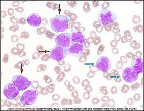 Acute monoblastic/monocytic leukaemia - CELL - Atlas of Haematological Cytology