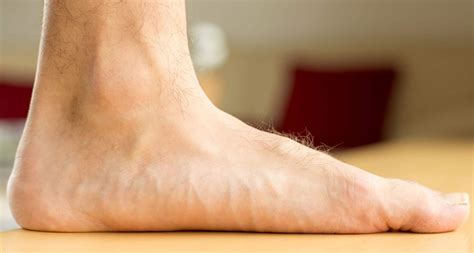 Pes Planus - Causes & Treatment for Flat Feet - Limbionics